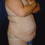 Tummy Tuck 29