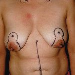 Tummy Tuck 29