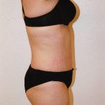 Tummy Tuck