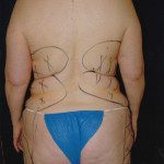 Liposuction 31