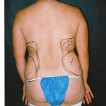 Liposuction 30