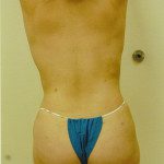 Liposuction