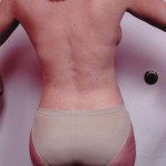 Liposuction