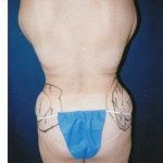 Liposuction 28