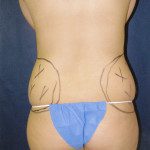 Liposuction 27