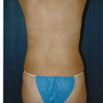 Liposuction