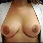 Breast Augmentation