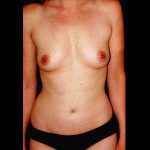 Breast Augmentation 2