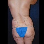 Liposuction 24