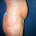 Liposuction