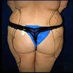 Liposuction 17
