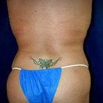 Liposuction