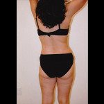 Liposuction