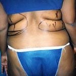 Liposuction 14