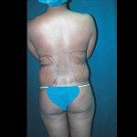 Liposuction 23