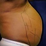 Liposuction 9