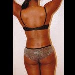 Liposuction