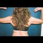 Liposuction 4