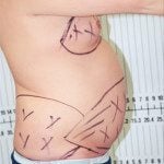 Liposuction 1
