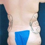 Liposuction 22