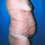 Tummy Tuck 13