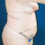 Tummy Tuck 12