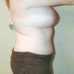 Tummy Tuck