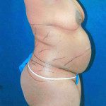 Tummy Tuck 11