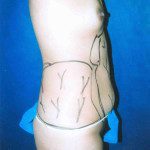 Tummy Tuck 10