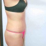 Tummy Tuck