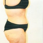 Tummy Tuck