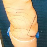 Tummy Tuck 8