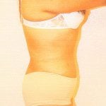 Tummy Tuck