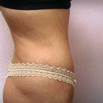 Tummy Tuck