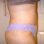 Tummy Tuck