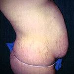 Tummy Tuck 5