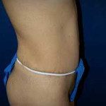 Tummy Tuck