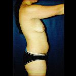 Tummy Tuck 1