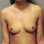 breast aug12-6