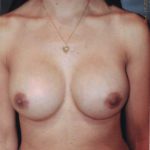 Breast Augmentation