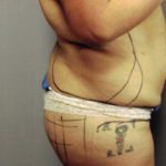lipo12-6