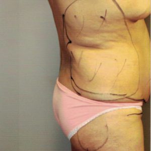 Lipo12-6