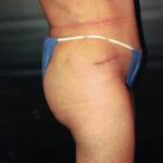 Brazilian Butt Lift