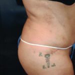 Brazilian Butt Lift