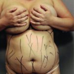 tickle lipo12-6
