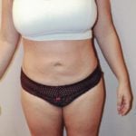 Liposuction