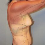 tummy tuck 12-6