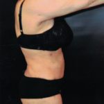 Liposuction