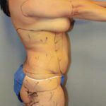 vaser lipo 12-6