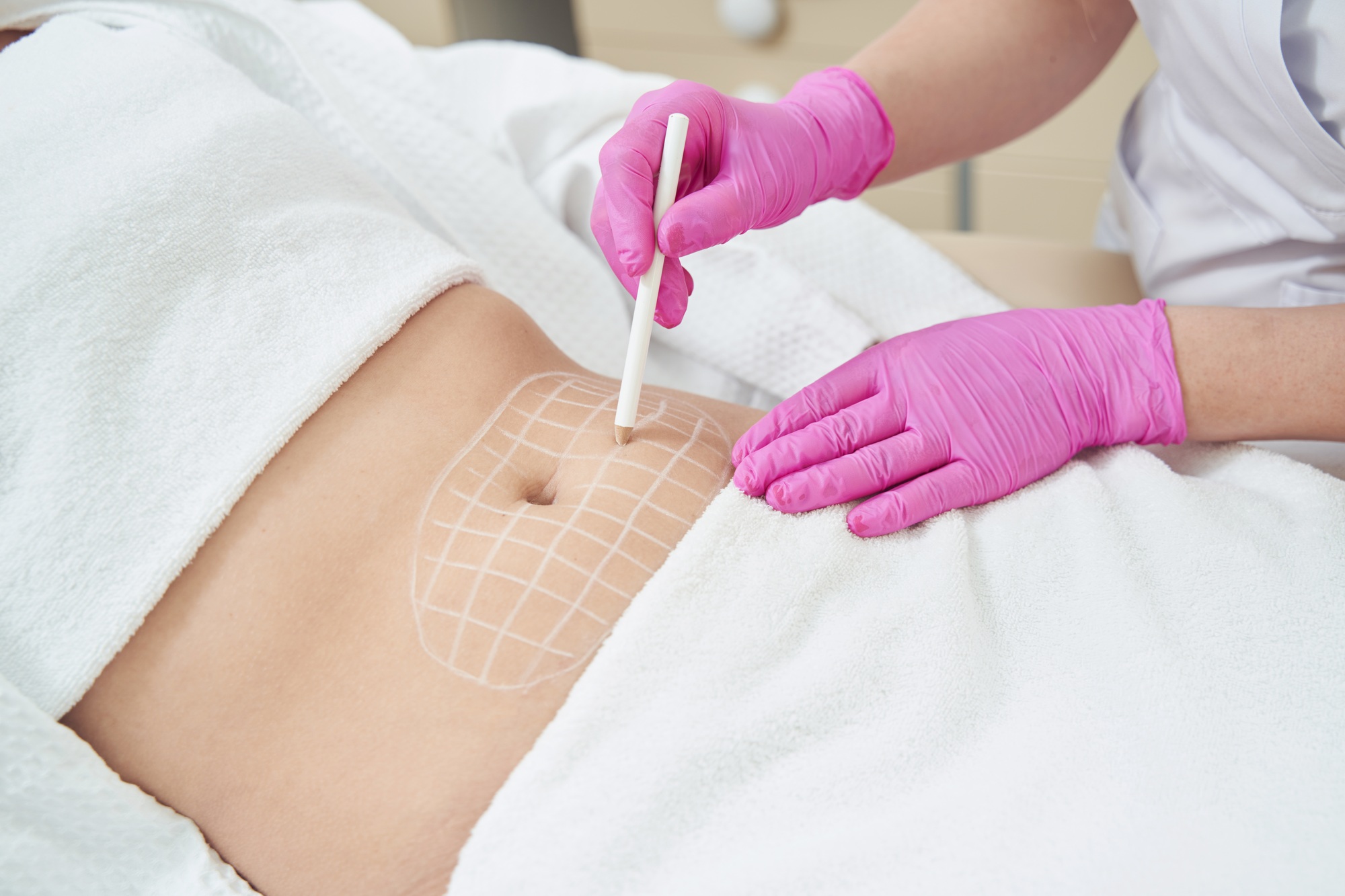 Fat Removal Surgery Trends at Temecula Body Contouring